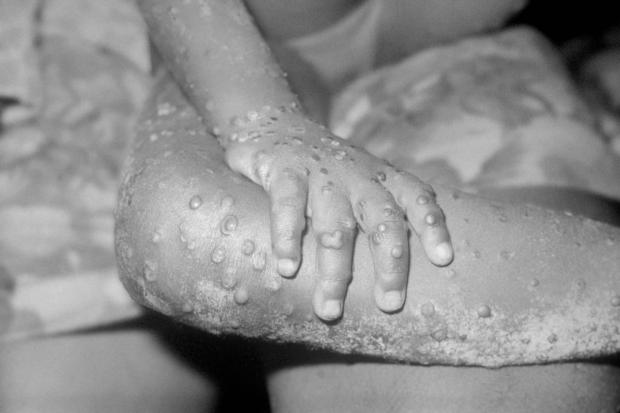 Richmond and Twickenham Times:  Eleven more cases of monkeypox have been confirmed in the UK, bringing the total to 20 (Alamy/PA)